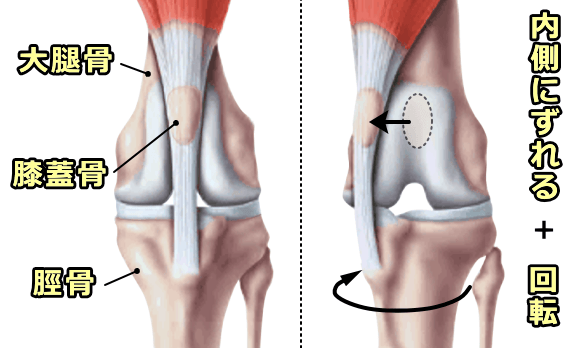 膝関節の構造と膝蓋骨内方脱臼の模式図