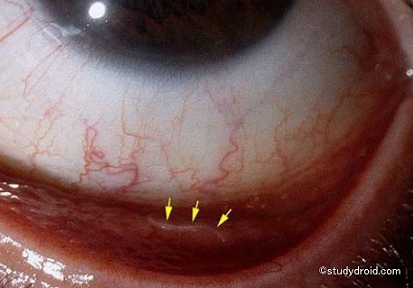人間の眼球内に発症した幼虫移行症