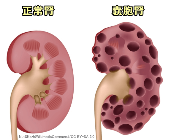 腎臓内に形成された多発嚢胞