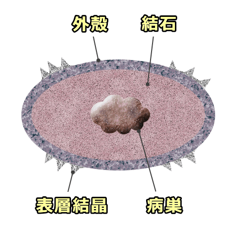 猫の尿石断面模式図～1つの尿石内に複数の層が含まれる
