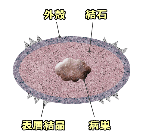 猫の尿石断面模式図~1つの尿石内に複数の層が含まれる