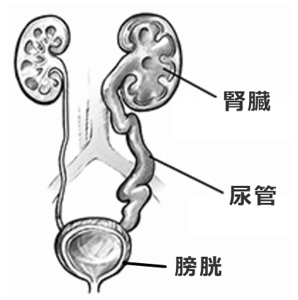水腎症の模式図～膨張した腎臓と尿路の閉塞