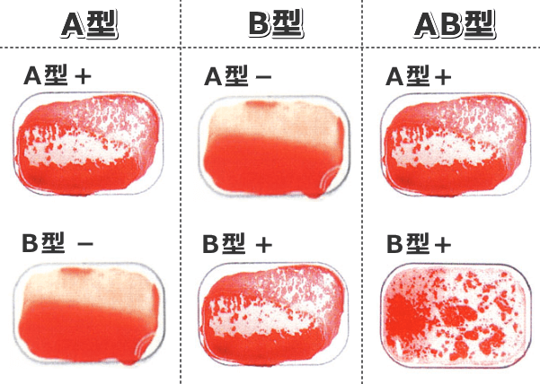 血液型の簡易検査キットを用いた場合、カードに塗りつけてある抗体への凝集反応で血液型を判定する