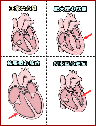 正常な心臓と各種心筋症（肥大型・拡張型・拘束型）の比較図