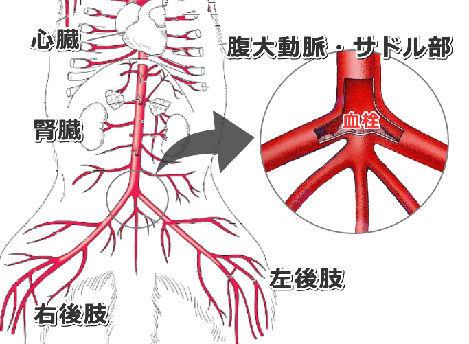 猫における動脈血栓塞栓症（ATE）の好発部位～腹部大動脈下端にあるサドル部