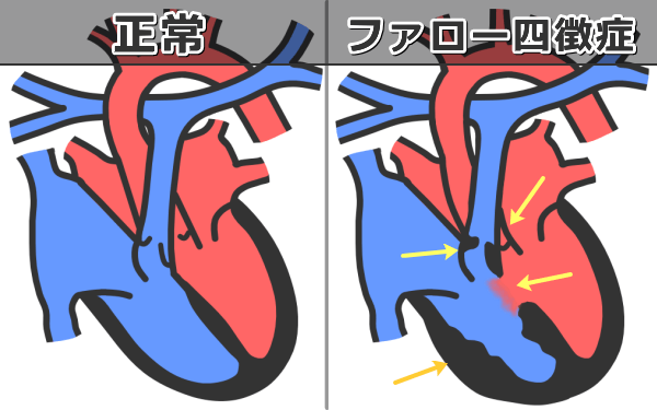 猫のファロー四徴症の病態~肺動脈狭窄、心室中隔欠損、右心室肥大、大動脈の右方転移(大動脈騎乗)の模式図