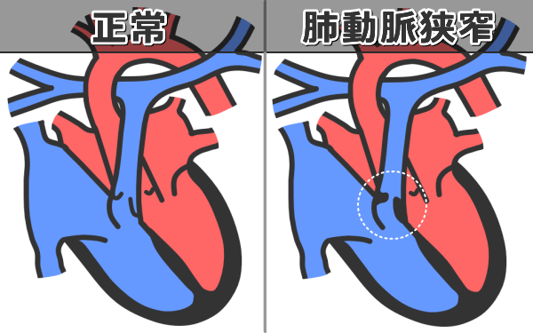 猫の肺動脈狭窄症の病態