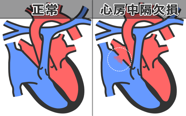 心房中隔欠損症の病態~心房と心房の間に卵円孔と呼ばれる先天的な通過孔が見られる