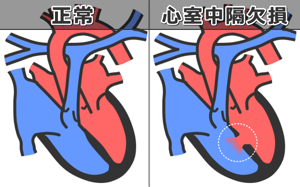 猫の心室中隔欠損症～心室間の壁に穴が空き、左心室からの血液が右心室に乱入している
