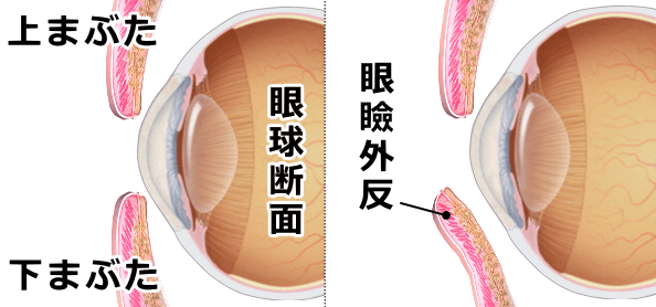 猫の眼瞼外反の模式図