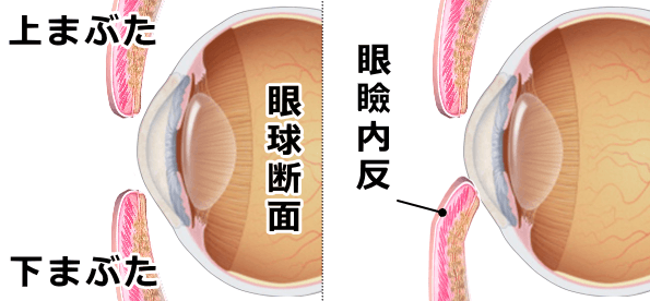 猫の眼瞼内反の模式図