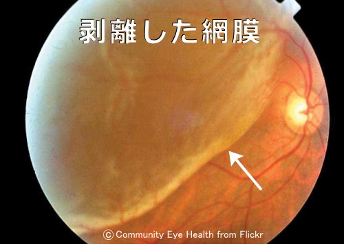 眼底鏡で見える剥離した網膜