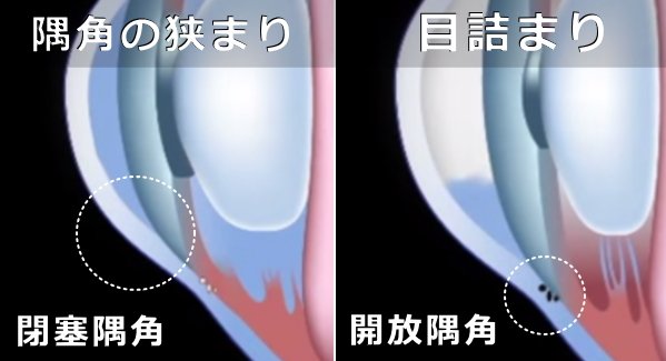 緑内障の発症パターン~開放隅角と閉塞隅角