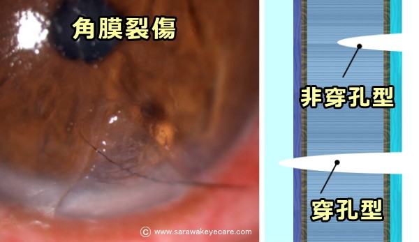 眼球に起こった角膜裂傷と穿孔型・非穿孔型の模式図