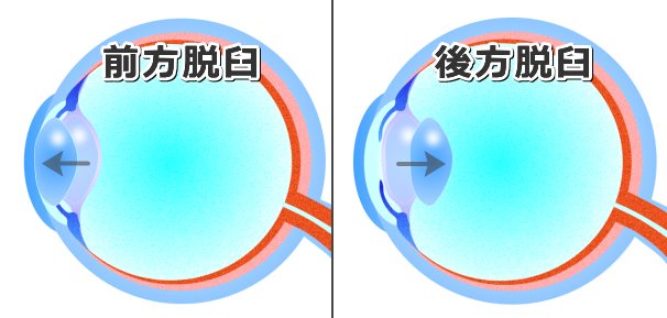 水晶体脱臼のタイプ~前方脱臼と後方脱臼