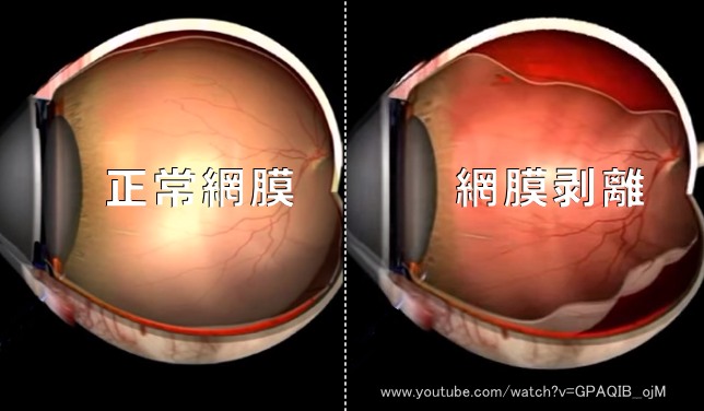 正常な網膜と剥離を起こした網膜の比較図
