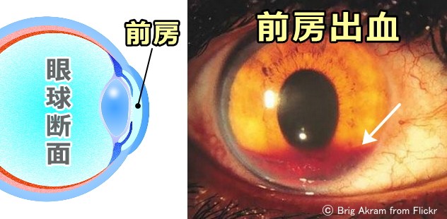 前房出血~前房内に血液が貯留している
