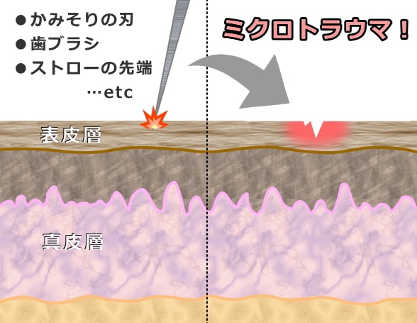 猫ニキビを強引に取ろうとすると表皮の最上面にミクロトラウマを作って炎症を引き起こす