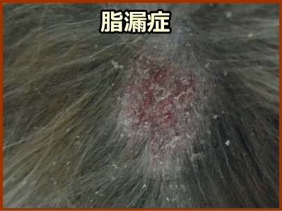 脂漏症（マラセチア皮膚炎）に特徴的な脂性落屑