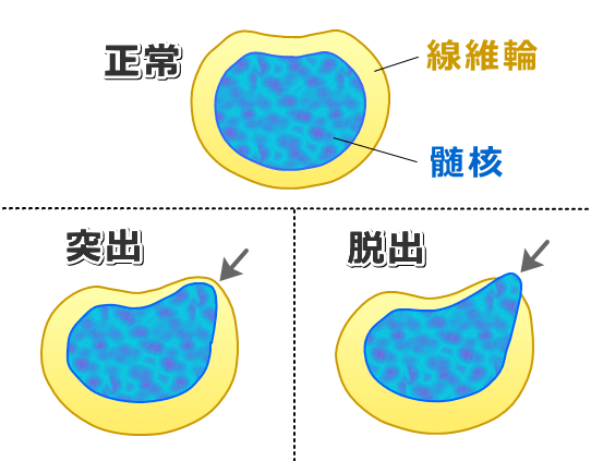 正常椎間板と髄核突出、髄核脱出の模式図