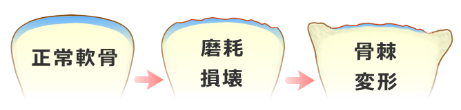 変形性関節症の進行~軟骨の変性損壊から骨棘の形成