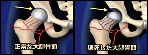 正常な大腿骨頭と壊死を起こした大腿骨頭の比較図