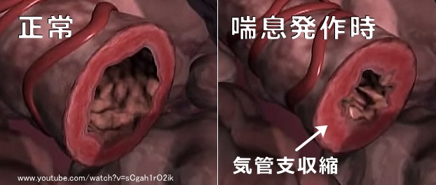 正常時と喘息発作時の猫の気管支比較図