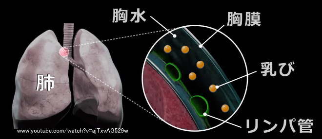 乳び胸の模式図～肺の胸膜とリンパ管経由の乳び