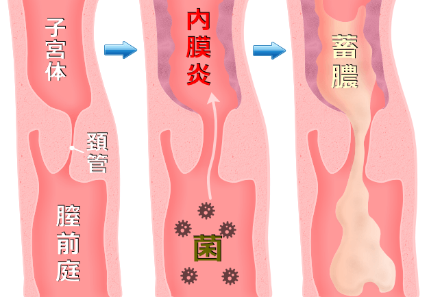 子宮内膜炎から子宮蓄膿症に悪化した様子