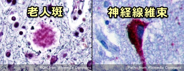 アルツハイマー型認知症の原因物質として目されている老人斑と神経線維束