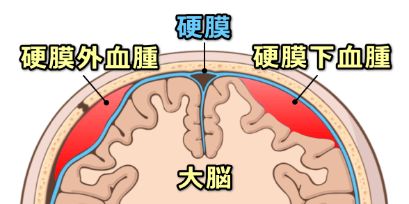 硬膜下血腫と硬膜外血腫の模式図・模式図