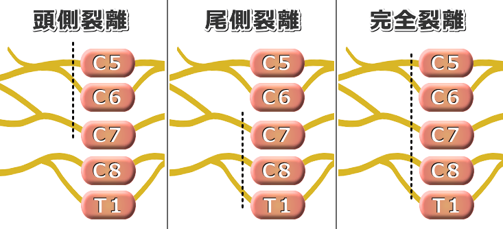 腕神経叢裂離の3タイプ～頭側・尾側・完全