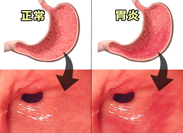 健康な胃と胃炎を起こした胃の肉眼的、および内視鏡的外観比較写真