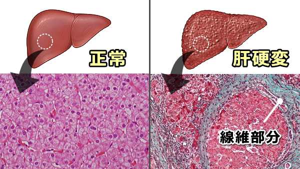 正常な肝臓と肝硬変に陥った肝臓の比較図