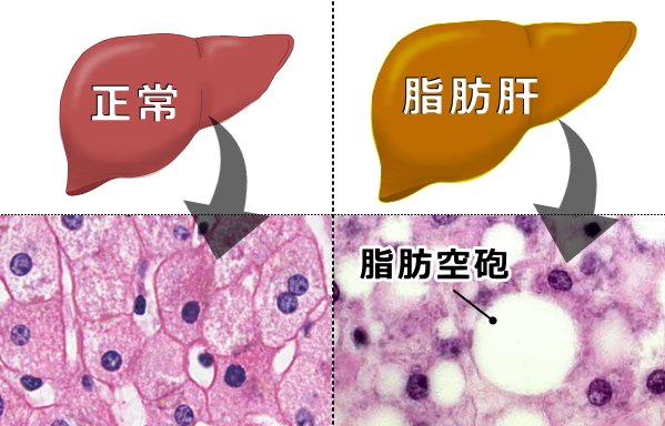 正常な肝臓と脂肪肝の肉眼的、および顕微鏡的比較図