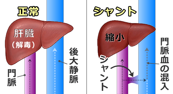 猫の門脈体循環シャント模式図～正常な血液の流れとシャントにおける異常循環