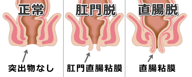 肛門直腸粘膜が飛び出す「肛門脱」（脱肛）と、直腸が飛び出す「直腸脱」（脱腸）