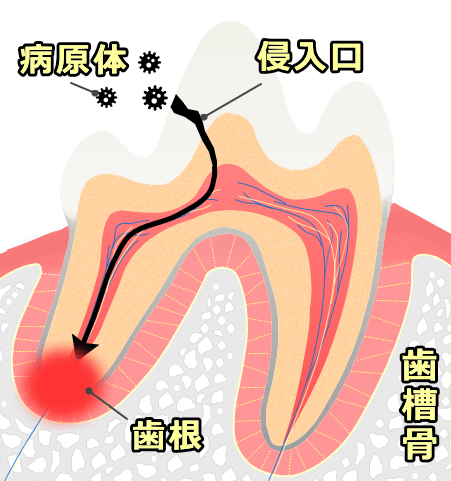 歯根膿瘍の模式図~病原体の侵入口と歯根部における炎症