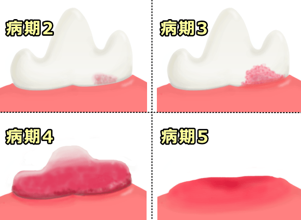 歯根吸収の病気2~5