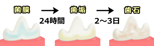 歯周病を招く菌膜・歯垢・歯石の模式図
