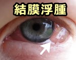 病原体に対する炎症で発生した結膜浮腫（白目スライム）