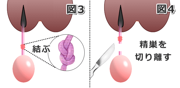 精巣に付属している血管と輸精管を固く結んだら精巣を切り離す