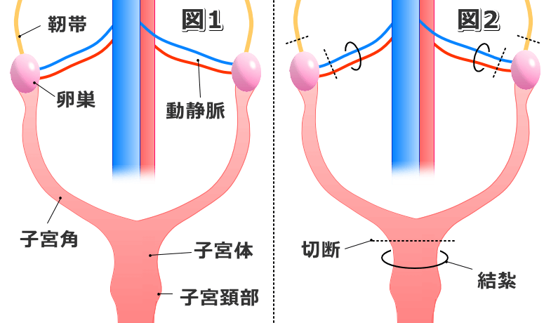 メス猫の避妊手術で結紮する部分と切断する部分の模式図