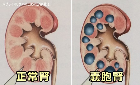 正常な腎臓と多発性嚢胞腎（PKD）を発症した腎臓の比較模式図