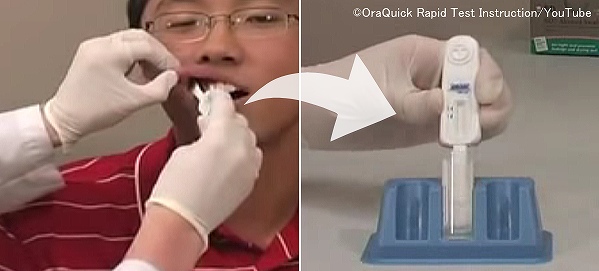 人間のHIV(エイズ)を検査するときの手順