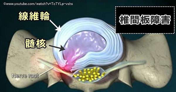 椎間板障害の模式図