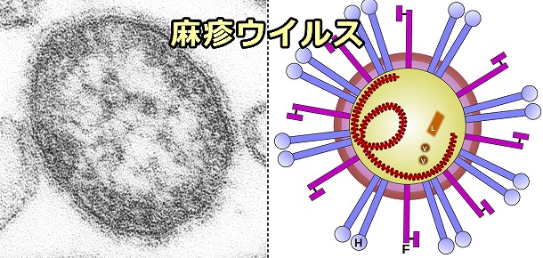モルビイリウイルスの一種麻疹ウイルス