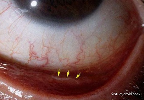 人間の眼球内に発症した幼虫移行症