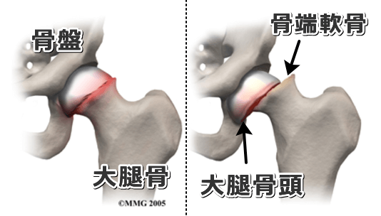 大腿骨頭すべり症では骨端軟骨部でせん断力が働き、骨頭が変形してしまう