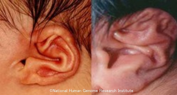 ビールス症候群（先天性拘縮性クモ指症）患者に特徴的な折れ曲がった耳